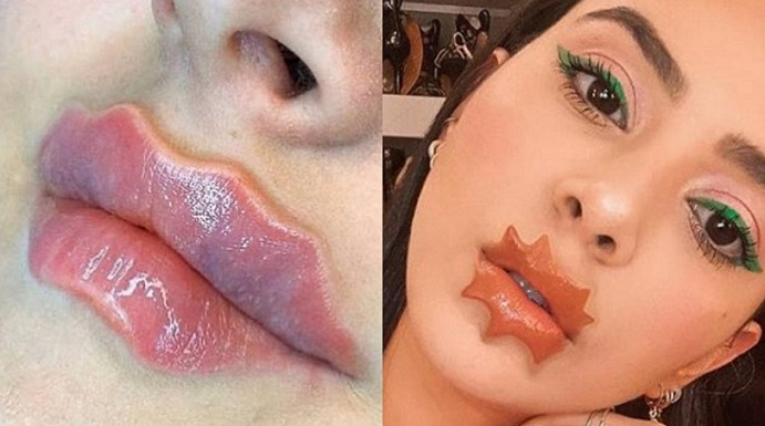 Labios del Diablo la peligrosa tendencia quirúrgica que está a la moda en las redes